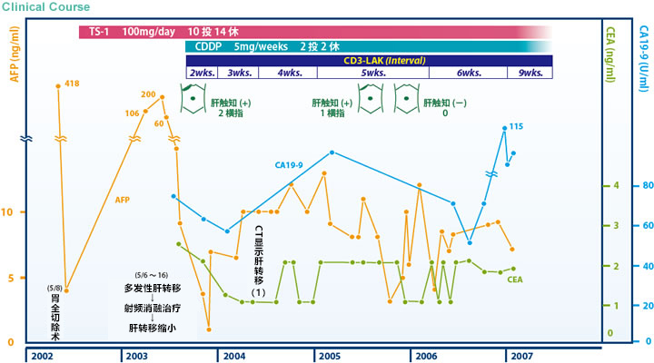 日本免疫细胞治疗(濑田诊所)：胃癌，女，62岁