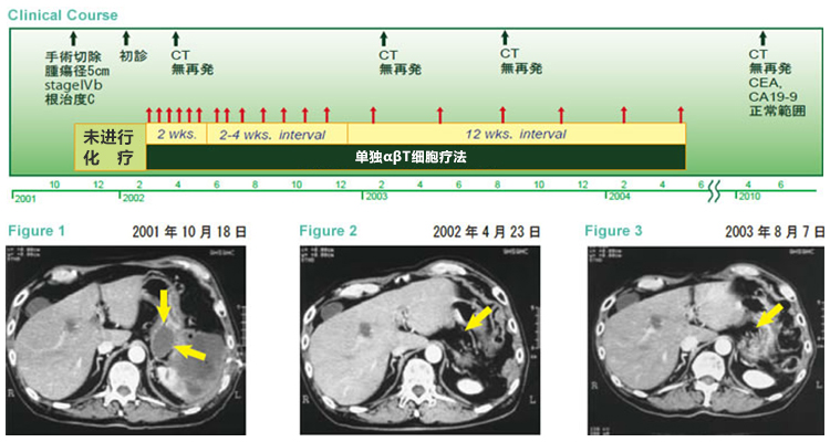 日本免疫细胞治疗(濑田诊所)：胰腺癌，男，70岁