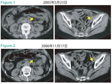 子宫内膜癌复发伴随远处转移案例图1