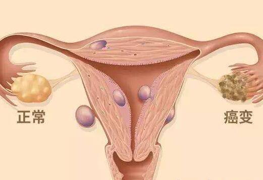 详解卵巢癌的复发治疗方法