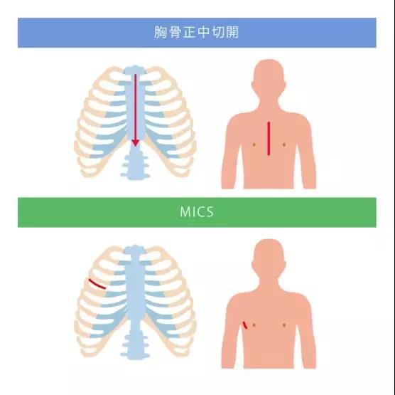 MICS(微创心脏手术)