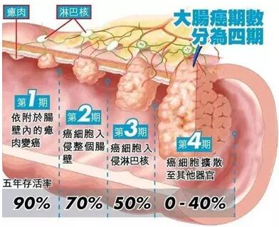 为什么要切除大肠息肉