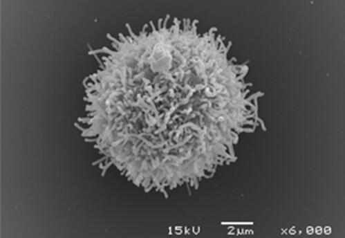 树突细胞免疫治疗在胰腺癌临床试验中取得重大突破