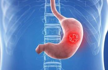 日本修订胃癌治疗指南 ：针对早期胃癌的ESD / EMR治疗