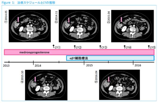 子宫内膜癌使用免疫细胞治疗效果如何？