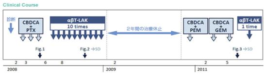 免疫细胞治疗之晚期非小细胞肺癌