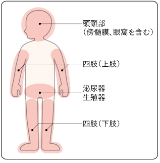 日本如何治疗儿童横纹肌肉瘤？