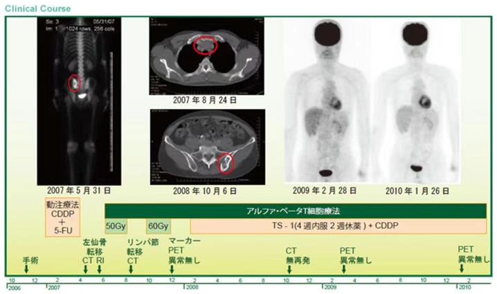 细胞免疫疗法之恶性黑色素瘤