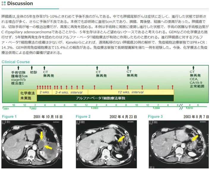 细胞免疫疗法之胰腺癌