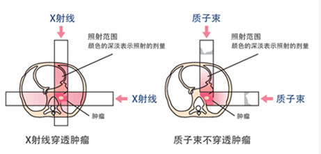 质子重离子治疗优势1