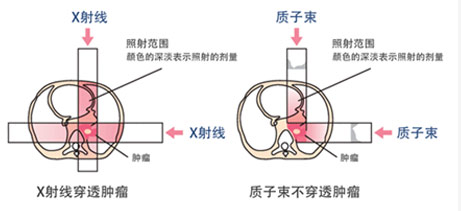 质子重离子治疗优势4